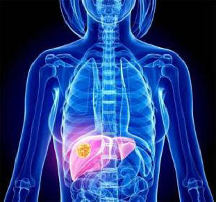 Bogati i siromašni pate od različitih vrsta karcinoma