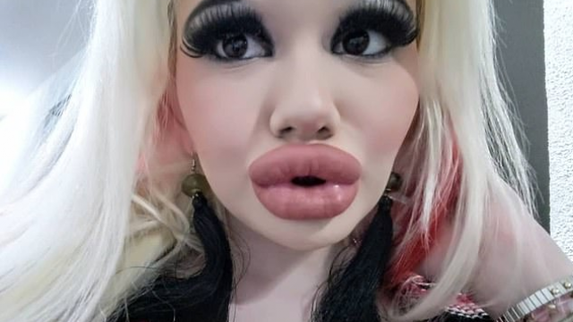 Bugarska studentica u potrazi za modom utrostručila usne