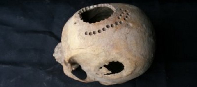 Stari su stanovnici Sibira znali kako uraditi operaciju mozga