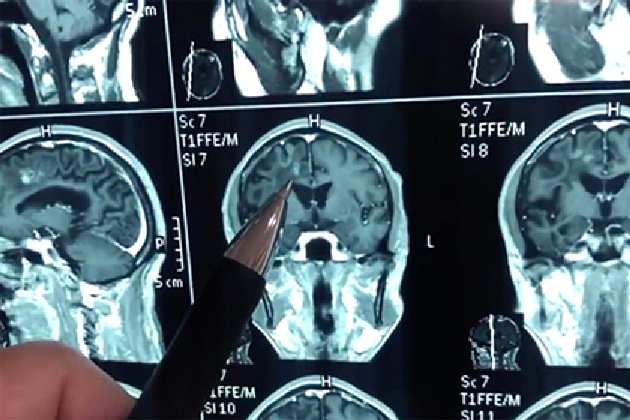 Kineskinja je živjela 30 godina sa ogromnim crvom u glavi.