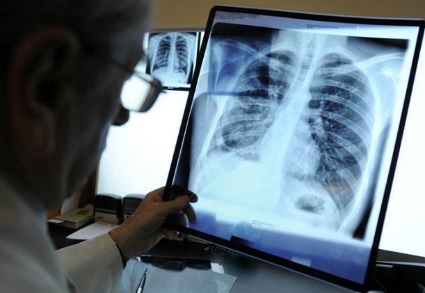 Kinez je slomio deset rebara zbog snažnog naleta kašlja: kriv je krema za sunčanje