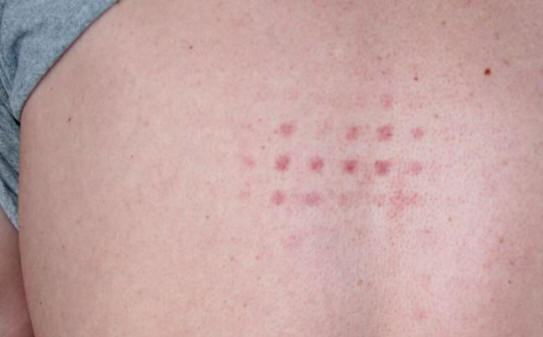 Odakle dolaze neobične tragove na tijelu?