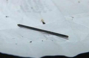 Akupunkturna igla proputovala je tijelo 40-godišnjeg muškarca