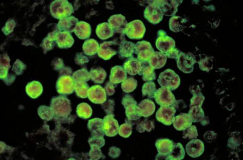 U Louisiani, voda je kontaminirana amebama koje jedu mozak.