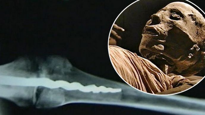 U mumiji je otkrivena ortopedska igla modernog dizajna