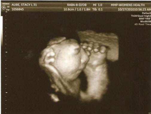 U Sjedinjenim Državama neobjašnjivo rastući slučajevi trudnoće s rijetkim deformitetom ploda