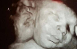 Dvoglava djevojčica rođena u SAD-u